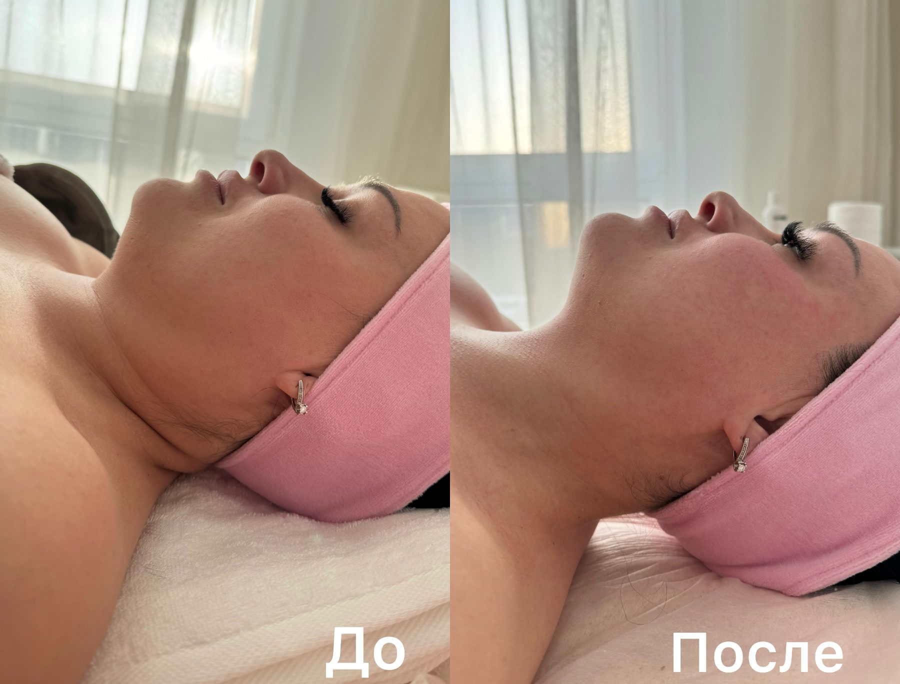 До и после — коррекция челюстного отдела