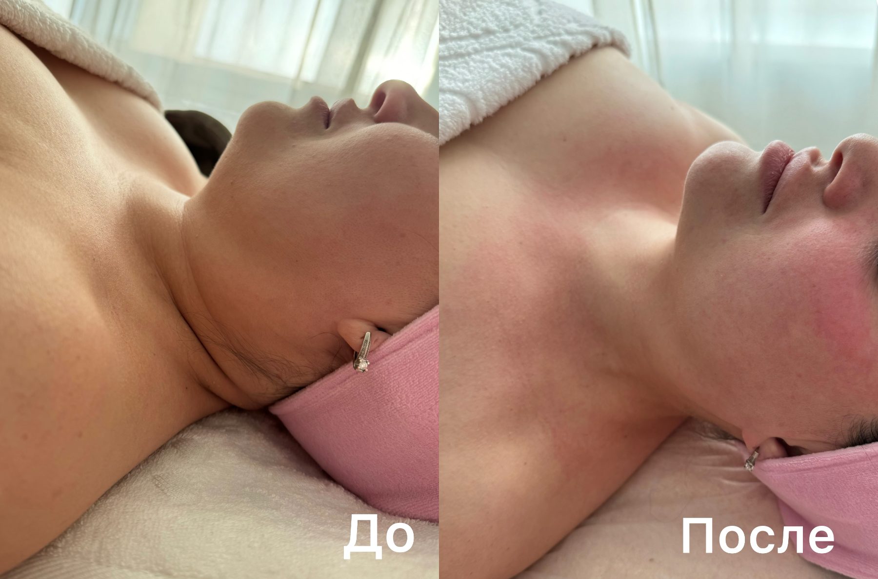 До и после — лимфодренажный массаж шеи